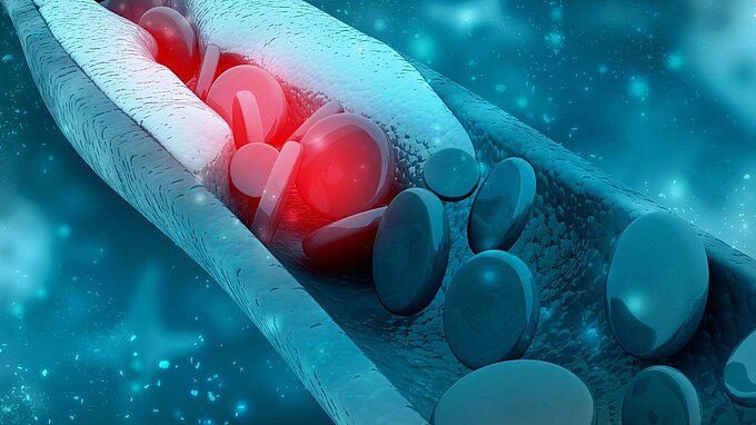 PI Ceramic - Cardiovascular Surgery